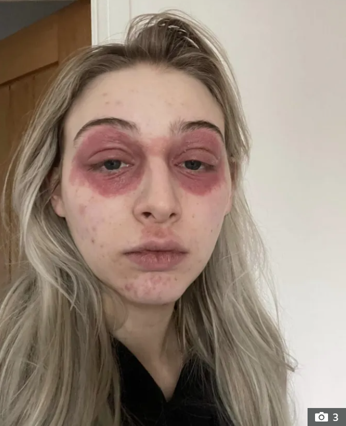 Дівчина потрапила до лікарні із зовнішністю "жертви чуми" через популярний засіб для вій (фото)